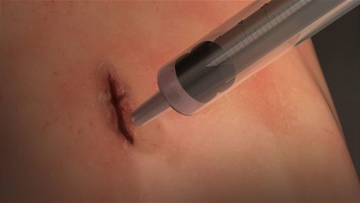 Researchers create a fast-sealing surgical ‘glue’ for closing wounds